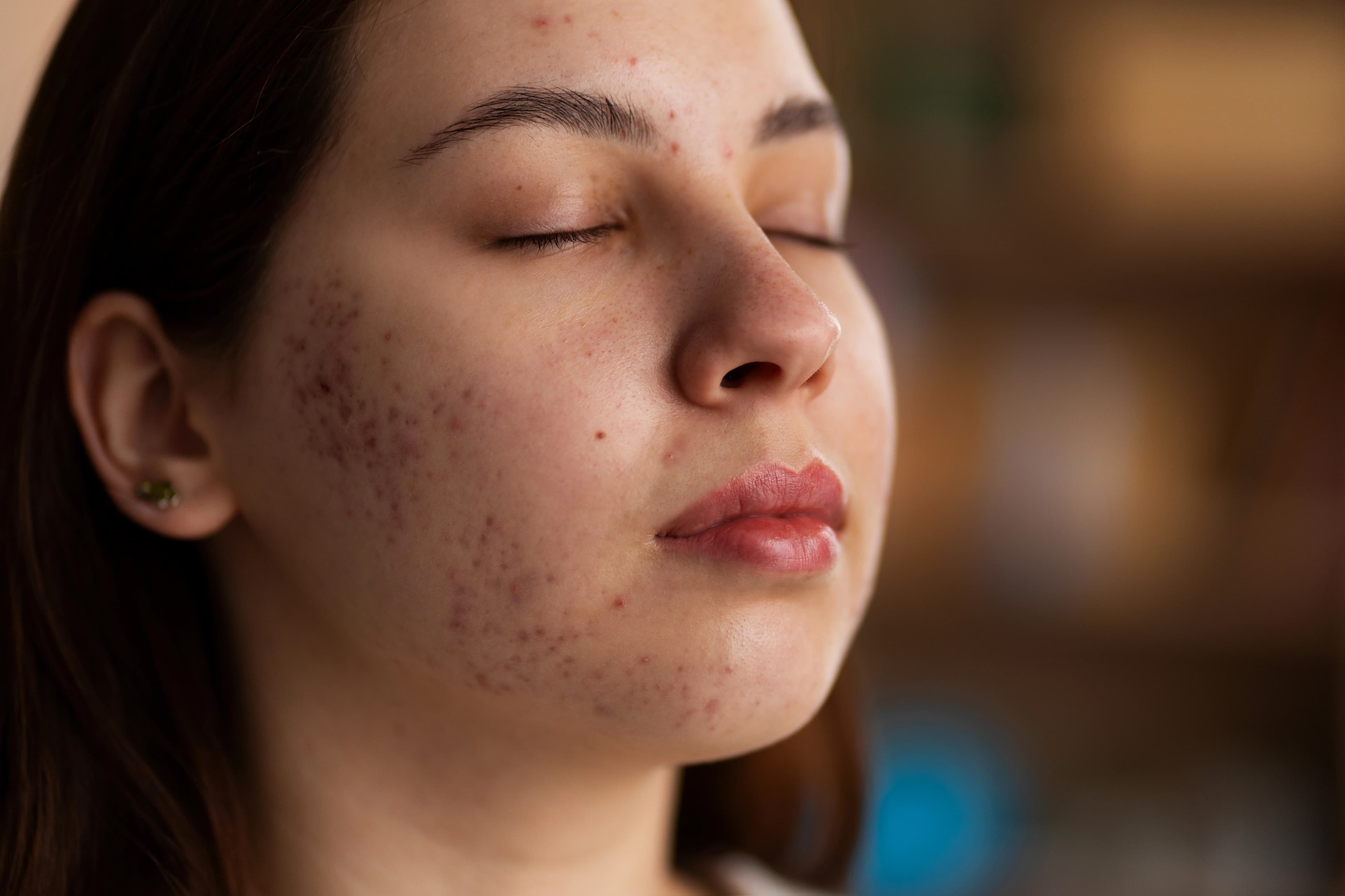 Acne treatment